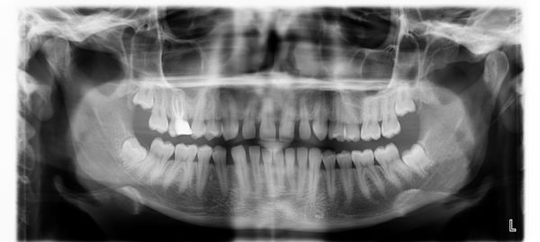 diente supernumerario