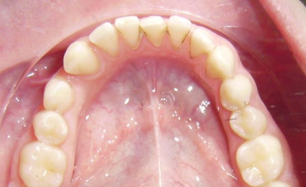 dientes supernumerarios colocados