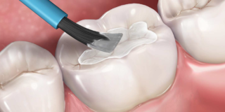 aplicación sellador en dientes de leche