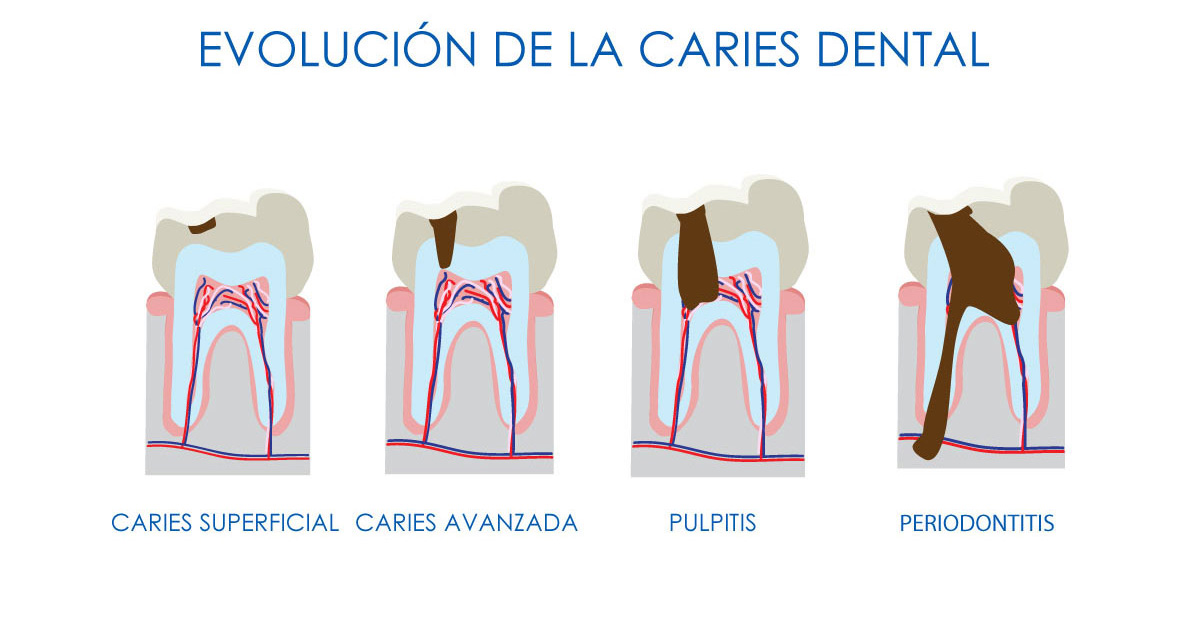 dolor de muelas, endodoncia