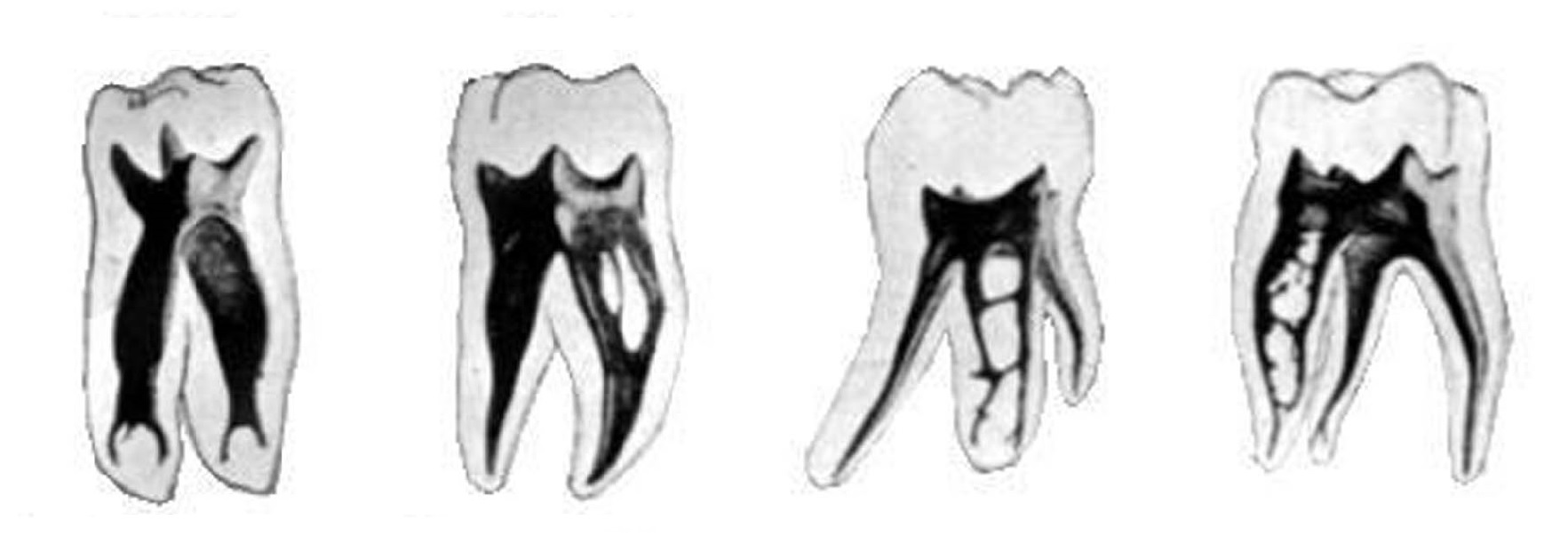 tratamiento de conductos Artedental Tenerife