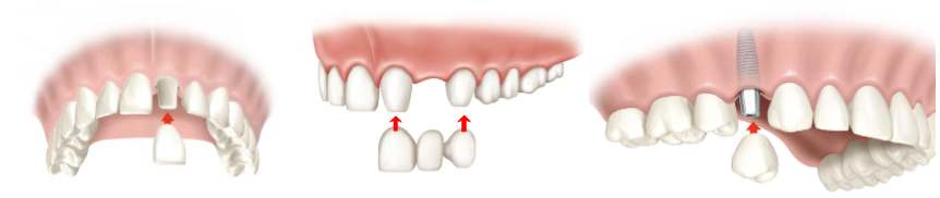 corona dental tenerife
