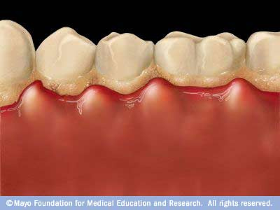 gum inflammation, pyorrhea