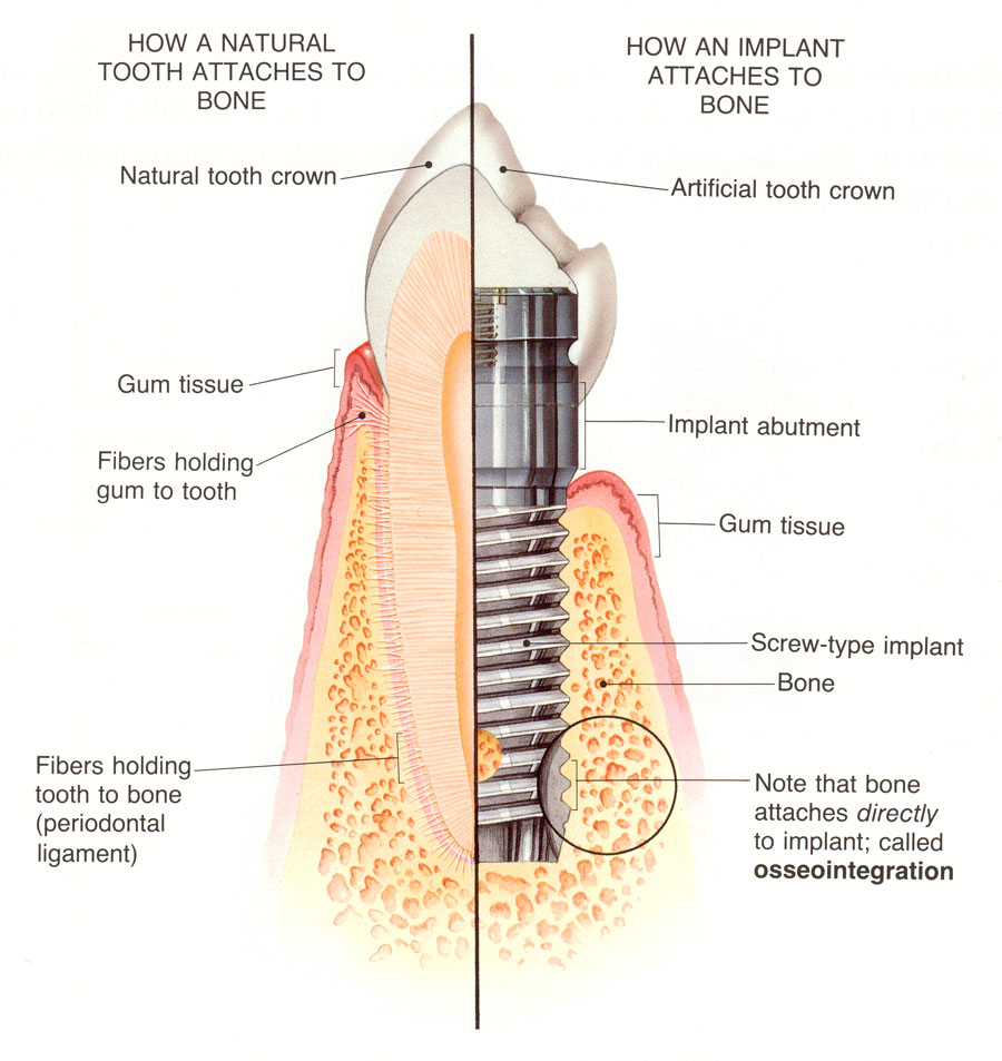 dental implants Tenerife