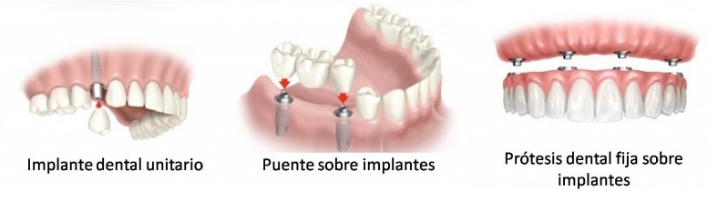 implante unitario, implantes dentales en Tenerife
