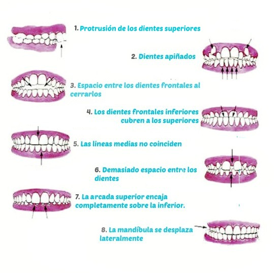 signos de maloclusión