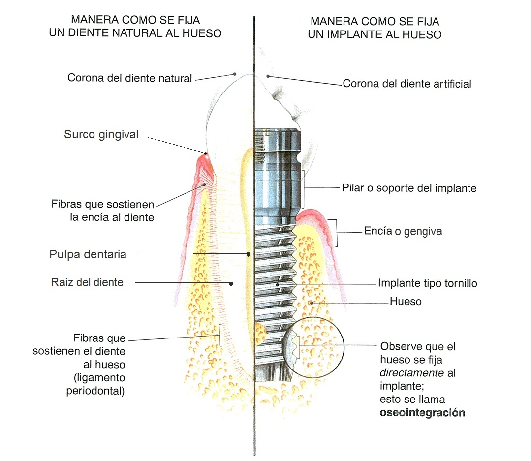 osteointegración de implantes dentales Puerto de la Cruz