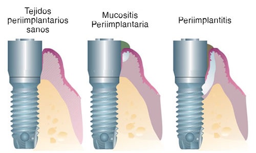 periimplantitis implantes Tenerife