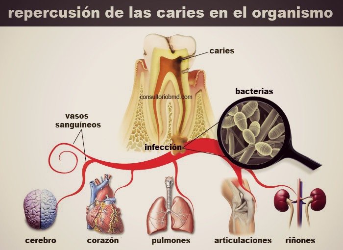 caries Artedental