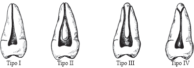 Tipos de conductos pulpares Artedental Tenerife