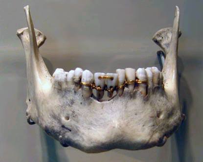 Puente dental de hace unos miles de años.