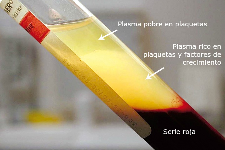 Plasma rico en factores de crecimiento