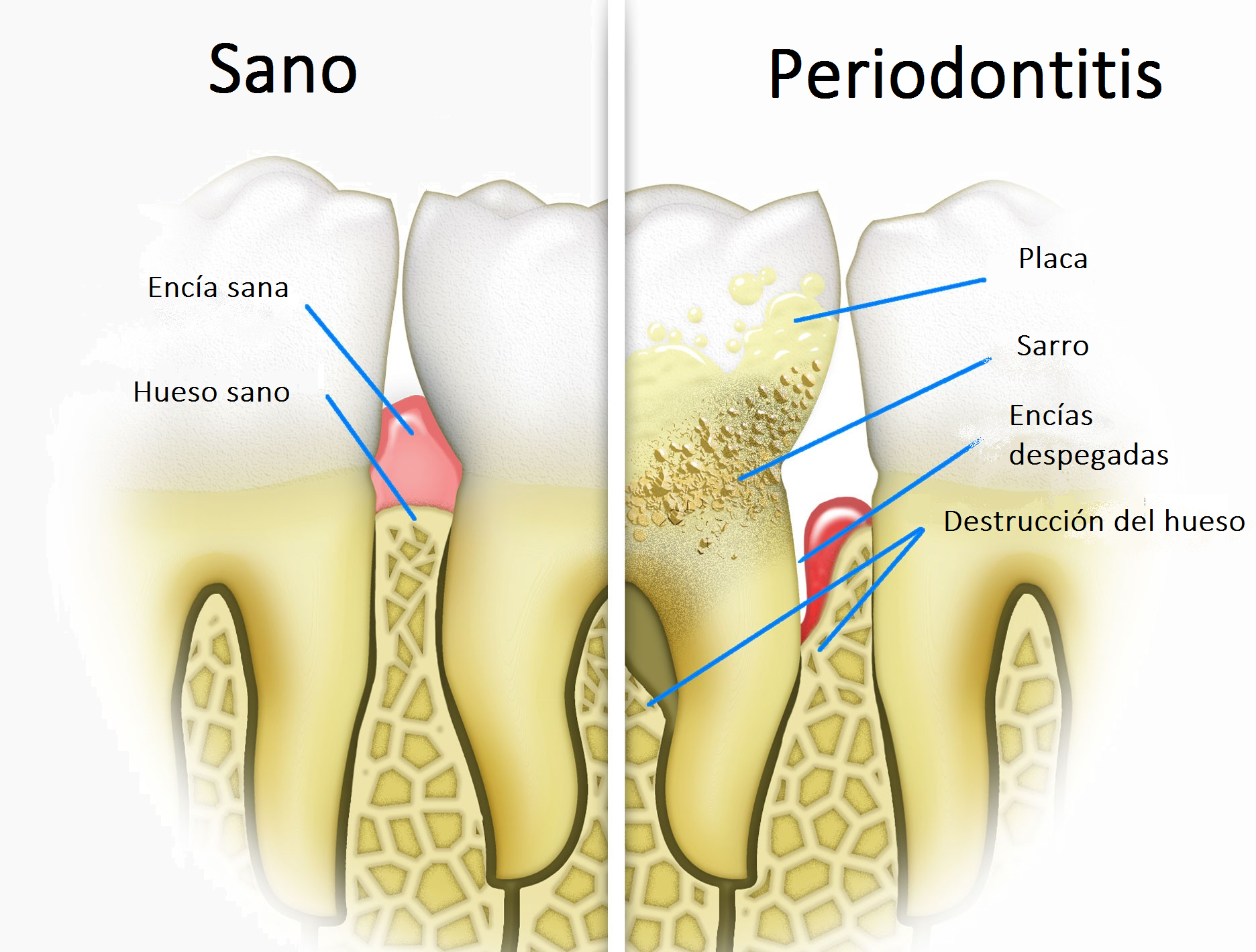 periodontitis y diabetes