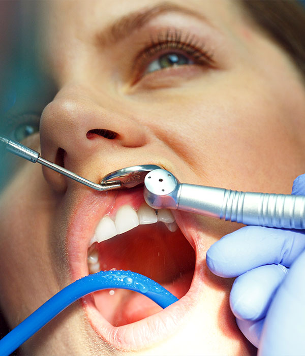 revisión dental caries