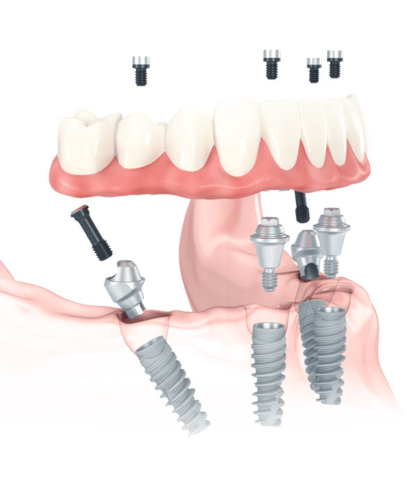 HYBRIDPROTHESE AUF IMPLANTATEN