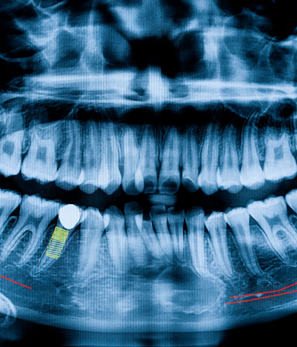 radiografía dental implante