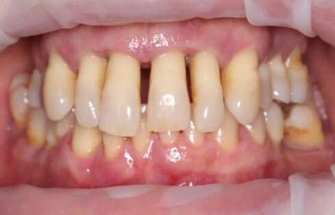 retracción de las encías. Dentista periodoncia Tenerife