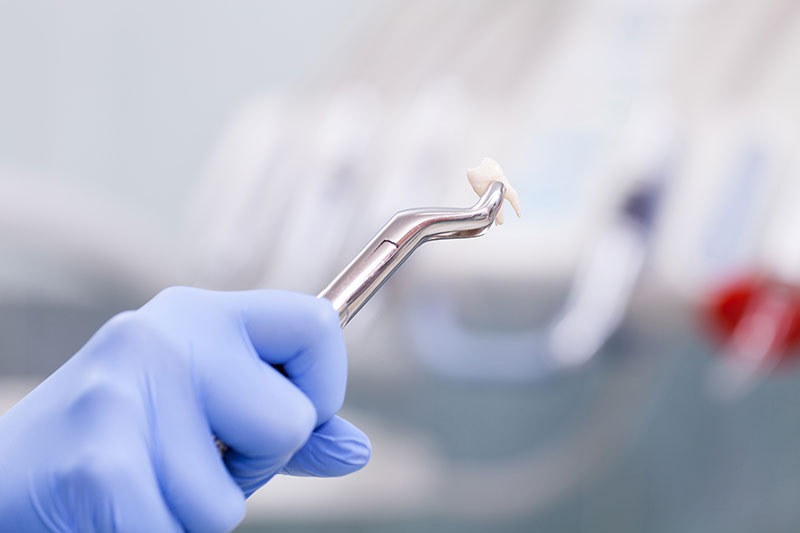 extracción y regeneración dental