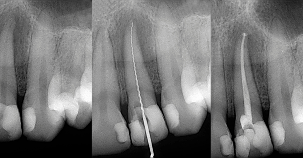 endodoncia en Tenerife, puerto de la cruz