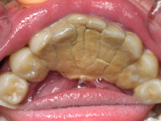 Der Zahnstein: Ursachen, Folgen und Lösungen auf Teneriffa